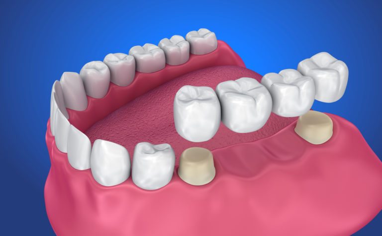 Crown Teeth Colour Chart